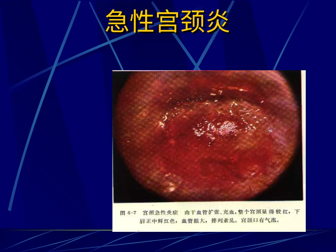 12妇产科 盆腔炎宫颈炎 预览图