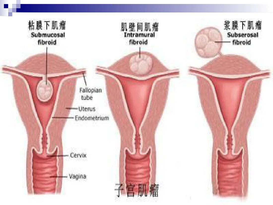 120.二病区子宫肌瘤健康宣教 预览图