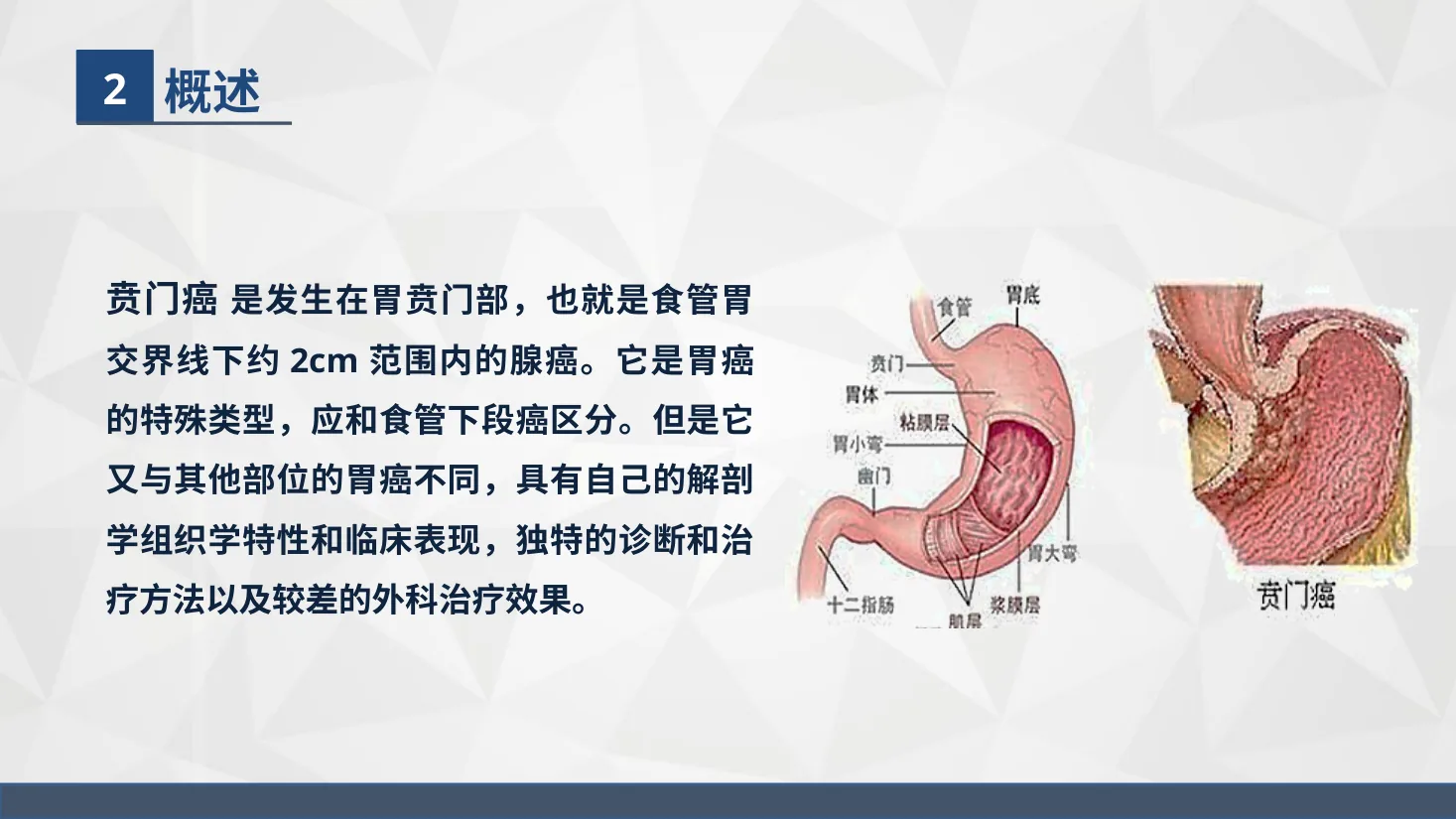 43普外科 贲门癌伴脓胸吻合口瘘护理查房 预览图