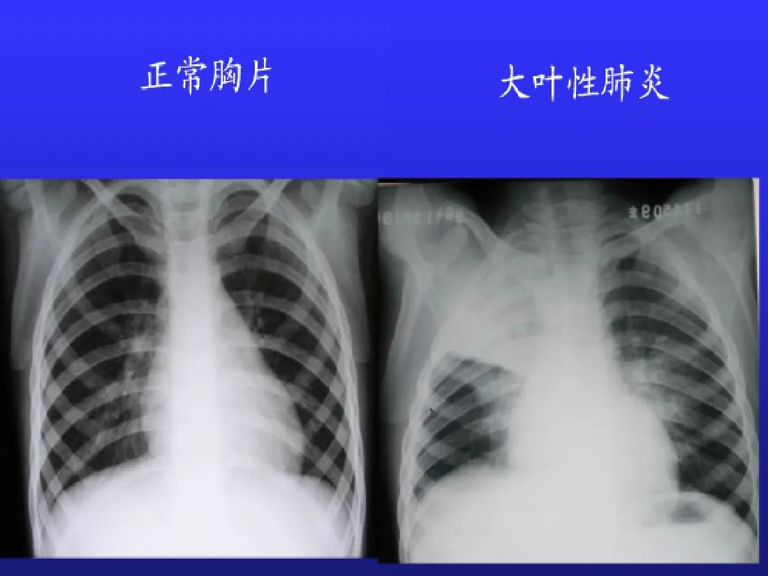 支气管肺炎 预览图